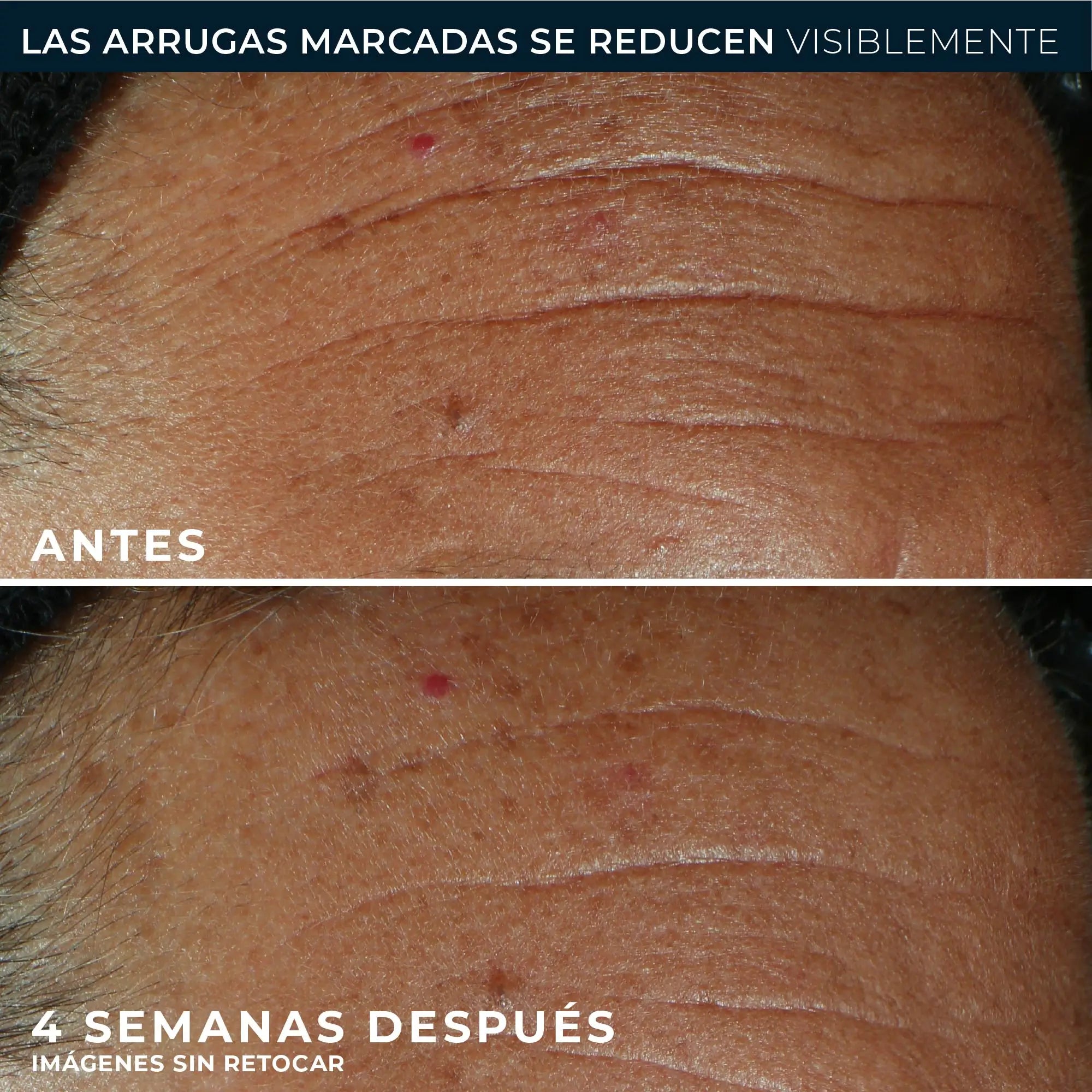 Roc Skincare Iberia Roc® Derm Correxion® Fill + Treat 15 ml